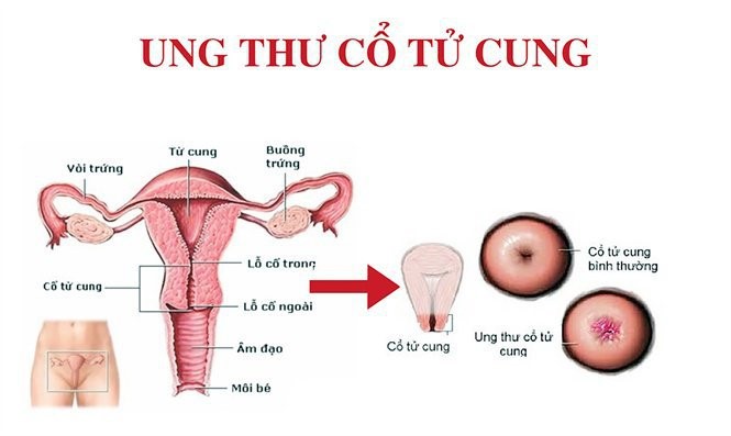 dấu hiệu bị ung thư cổ tử cung